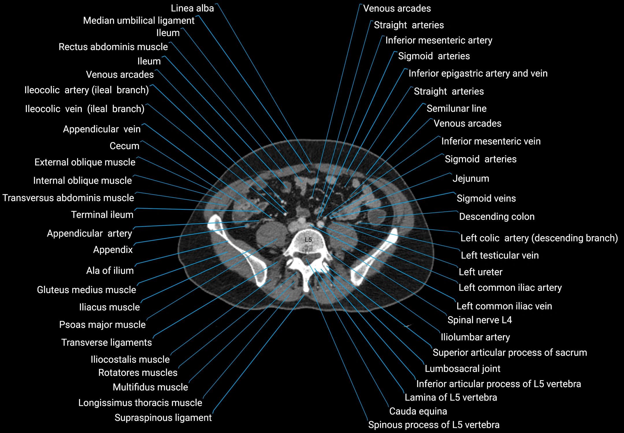 CT male pelvis axial cross sectional anatomy labelled radiology image -00126.webp